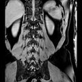Bilateral conjoined nerve roots at different levels (Radiopaedia 73312-84063 B 39).jpg
