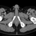 Bilateral direct inguinal herniae (Radiopaedia 17016-16719 B 29).jpg