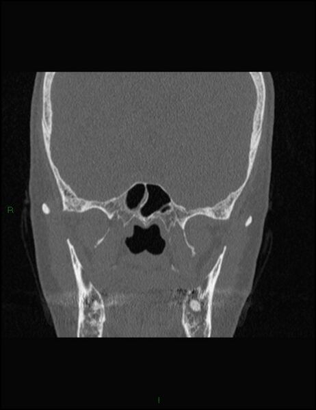 File:Bilateral frontal mucoceles (Radiopaedia 82352-96454 Coronal 231).jpg