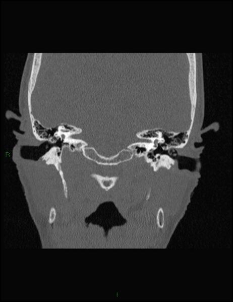 File:Bilateral frontal mucoceles (Radiopaedia 82352-96454 Coronal 308).jpg