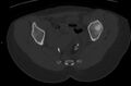 Bilateral mature cystic ovarian teratoma (Radiopaedia 88821-105592 Axial bone window 26).jpg