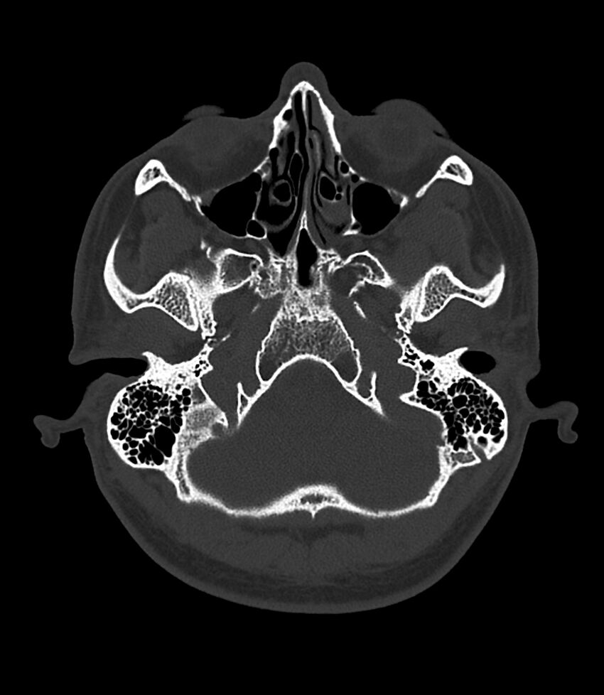 Bilateral medial canal fibrosis (Radiopaedia 85598-101344 Axial bone window 1).jpg