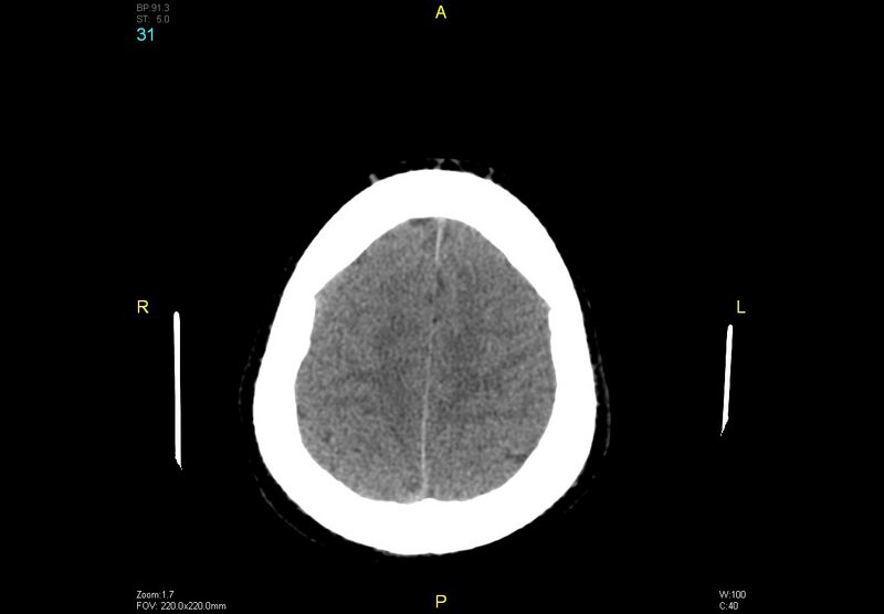 File:Bilateral medial medullary infarction (Radiopaedia 42220-45295 Axial non-contrast 31).jpg