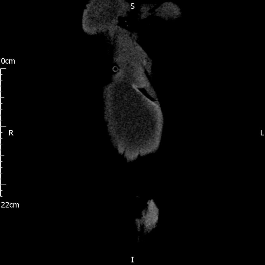 Bilateral medullary nephrocalcinosis with ureteric calculi (Radiopaedia 71269-81569 Coronal non-contrast 3).jpg