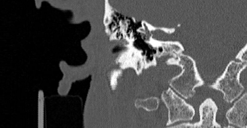 File:Bilateral temporal bone fractures (Radiopaedia 29482-29970 Coronal non-contrast 111).jpg