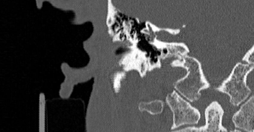Bilateral temporal bone fractures (Radiopaedia 29482-29970 Coronal non-contrast 111).jpg