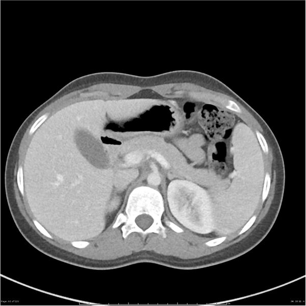 File:Bilateral ureteritis and cystitis (Radiopaedia 25340-25594 A 18).jpg