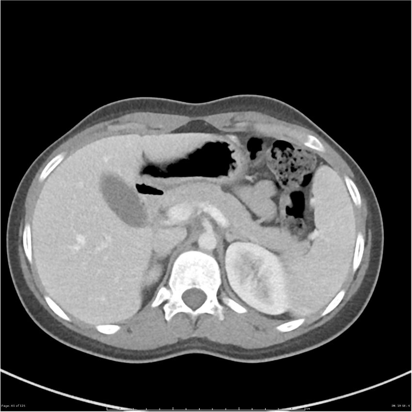 Bilateral ureteritis and cystitis (Radiopaedia 25340-25594 A 18).jpg