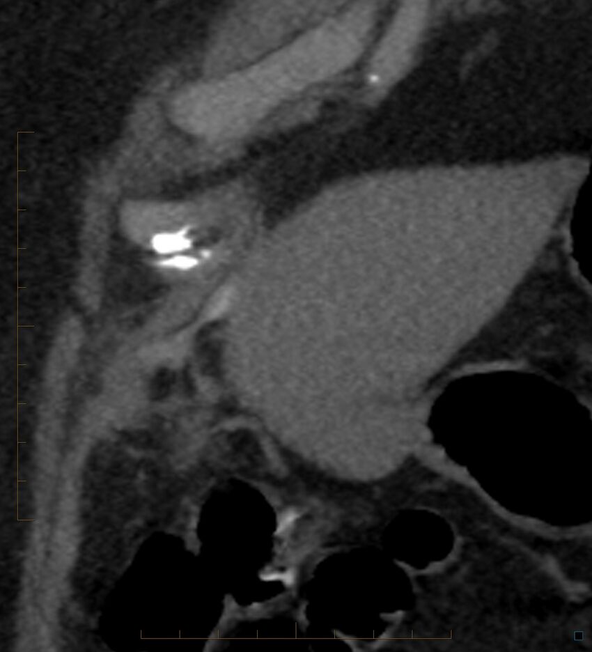 Bile leak from accessory duct(s) of Luschka post cholecystectomy (Radiopaedia 40736-43389 B 9).jpg