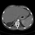 Biliary necrosis - liver transplant (Radiopaedia 21876-21846 A 13).jpg