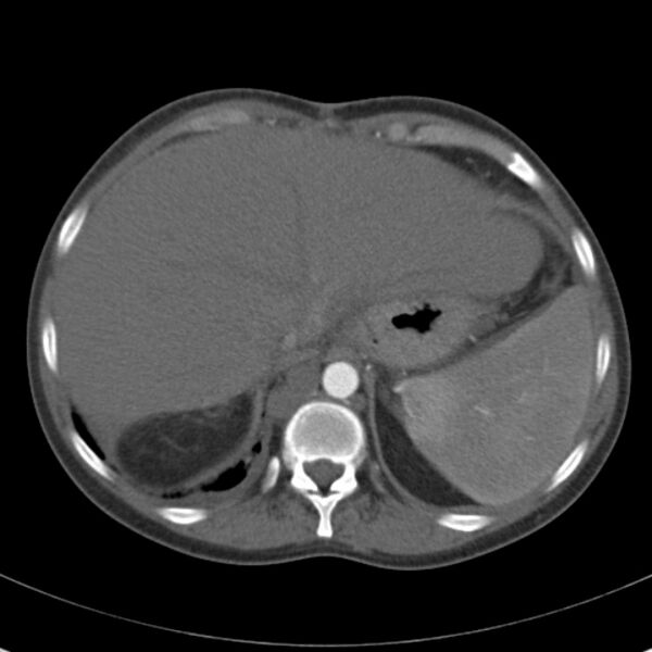 File:Biliary necrosis - liver transplant (Radiopaedia 21876-21846 A 13).jpg
