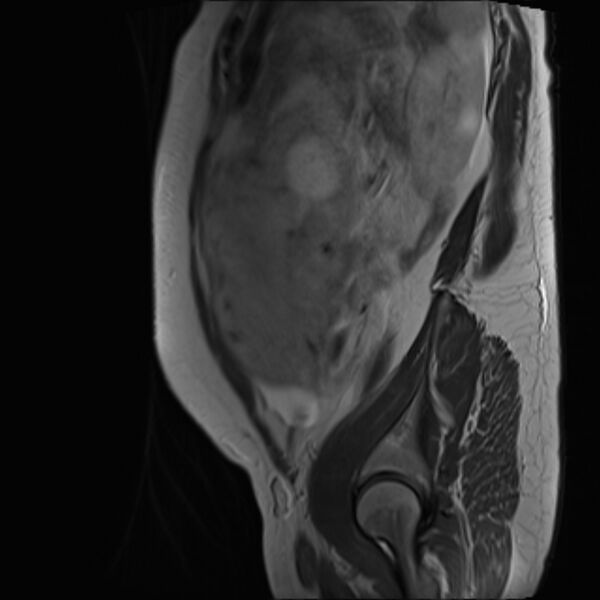 File:Bilobed placenta accreta (Radiopaedia 69648-79591 Sagittal T2 6).jpg