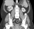 Bladder papillary urothelial carcinoma (Radiopaedia 48119-52951 C 44).png