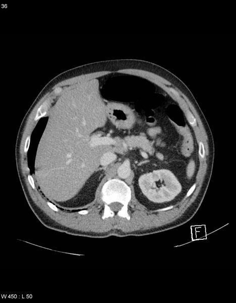 File:Boerhaave syndrome with tension pneumothorax (Radiopaedia 56794-63603 A 18).jpg