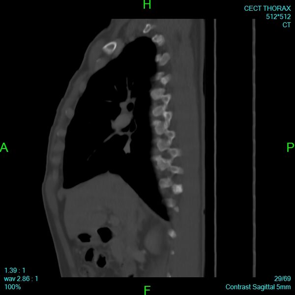 File:Bone metastases from lung carcinoma (Radiopaedia 54703-60937 Sagittal bone window 29).jpg