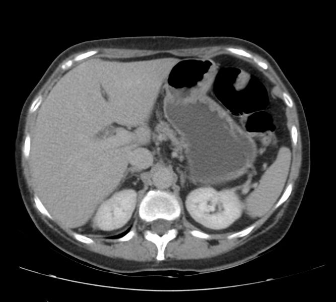 File:Bosniak renal cyst - type IV (Radiopaedia 22929-22953 D 15).jpg