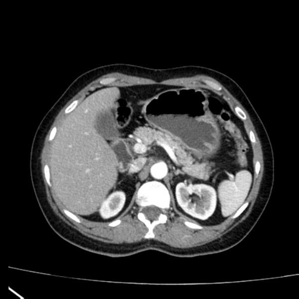 File:Bosniak renal cyst - type I (Radiopaedia 27479-27675 renal cortical phase 22).jpg
