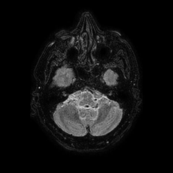 File:Brain abscess complicated by intraventricular rupture and ventriculitis (Radiopaedia 82434-96577 Axial FLAIR 11).jpg