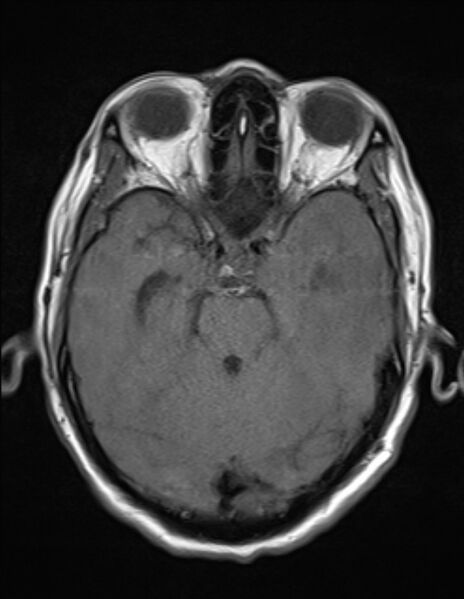 File:Brain abscess with ventriculitis (Radiopaedia 85703-101495 Axial T1 9).jpg