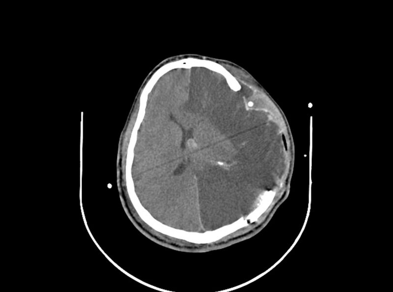 File:Brain injury by firearm projectile (Radiopaedia 82068-96087 B 119).jpg
