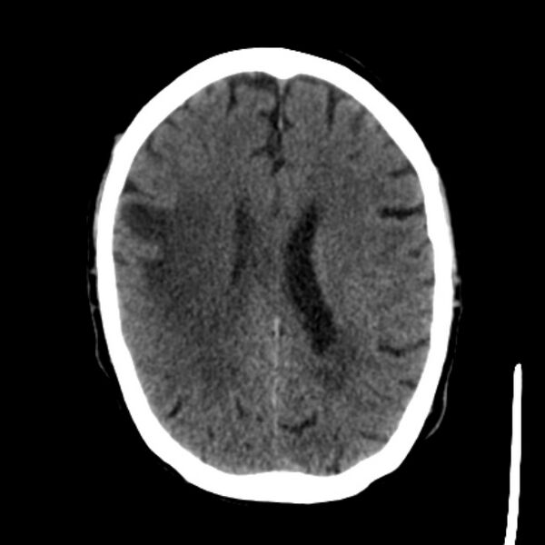File:Brain metastases from lung cancer (Radiopaedia 27849-28092 Axial non-contrast 29).jpg