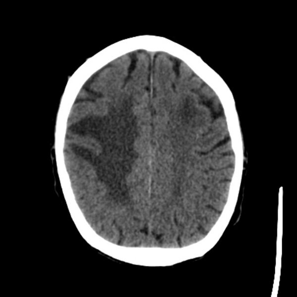 File:Brain metastases from lung cancer (Radiopaedia 27849-28092 Axial non-contrast 33).jpg