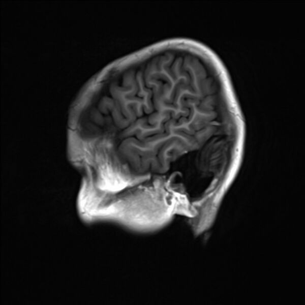 File:Brainstem glioma (Radiopaedia 70548-80674 Sagittal T1 1).jpg