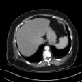 Breast carcinoma with pathological hip fracture (Radiopaedia 60314-67974 A 46).jpg