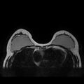 Breast implants - MRI (Radiopaedia 26864-27035 Axial T2 19).jpg