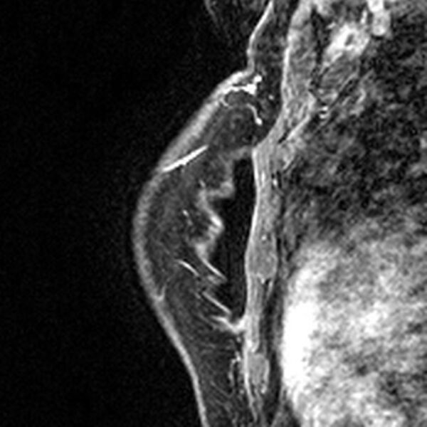File:Breast implants - MRI (Radiopaedia 26864-27035 Sagittal T2 46).jpg