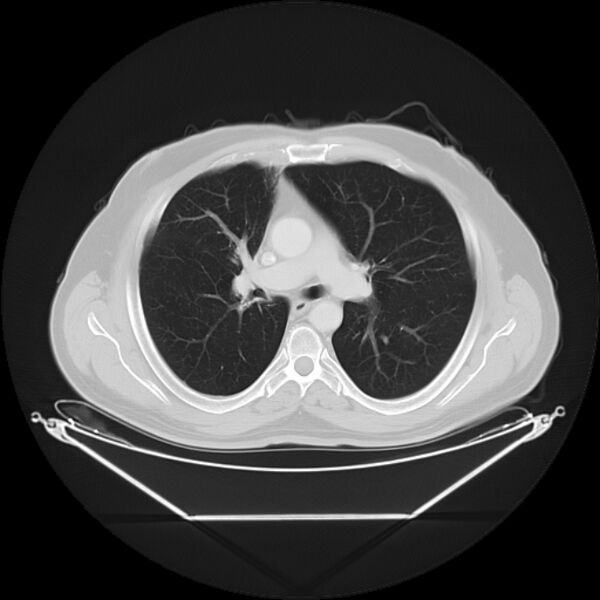 File:Bronchogenic carcinoma with upper lobe collapse (Radiopaedia 29297-29726 Axial lung window 15).jpg
