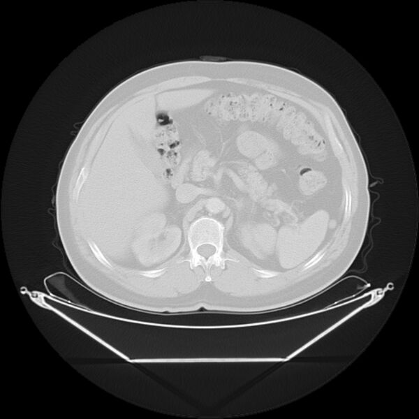File:Bronchogenic carcinoma with upper lobe collapse (Radiopaedia 29297-29726 Axial lung window 34).jpg