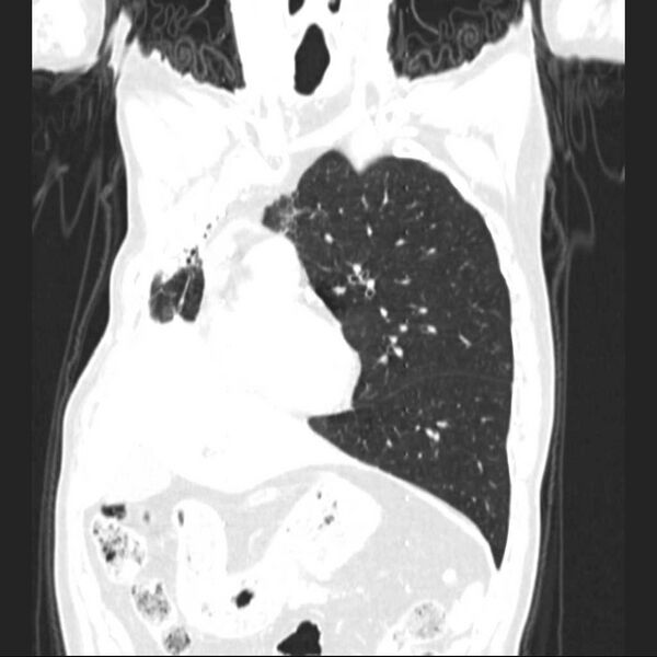 File:Bronchopleural fistula - postoperative complication (Radiopaedia 21020-20947 Coronal lung window 10).jpg