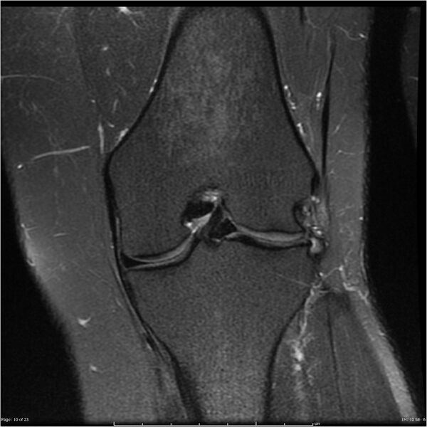 File:Bucket handle tear - lateral meniscus (Radiopaedia 7246-8187 Coronal T2 fat sat 10).jpg