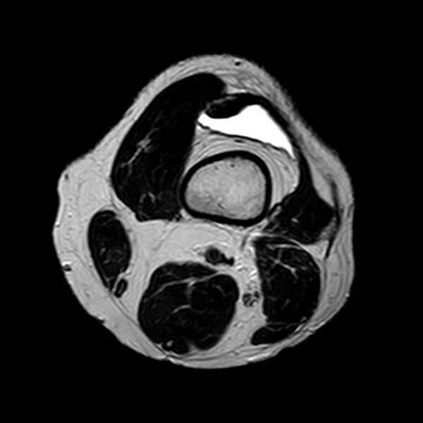 File:Bucket handle tear - medial meniscus (Radiopaedia 29250-29664 Axial T2 21).jpg