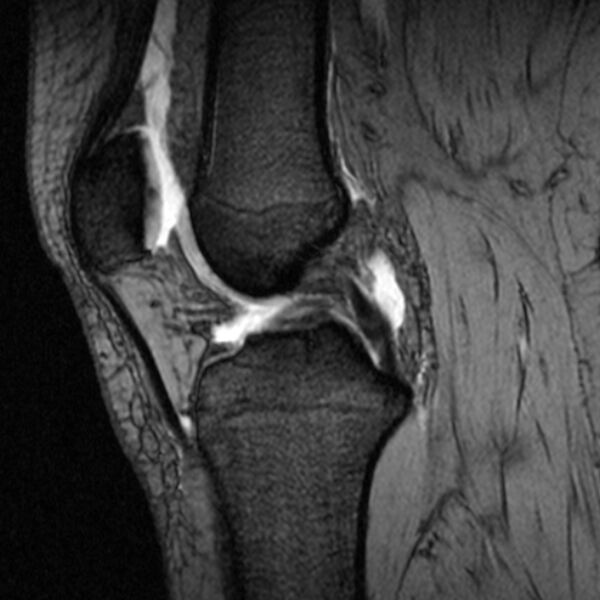 File:Bucket handle tear - medial meniscus (Radiopaedia 79028-91942 D 13).jpg