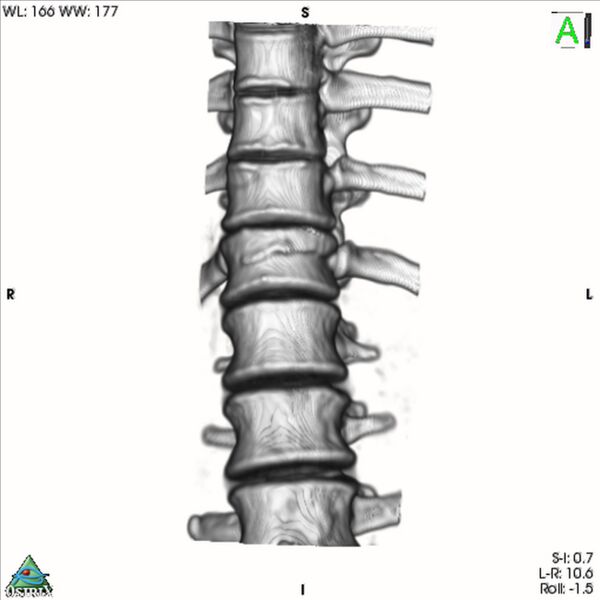 File:Bulging of paraspinal line in traumatic thoracal spinal compression fracture (Radiopaedia 29221-35872 3D VR 12).jpg