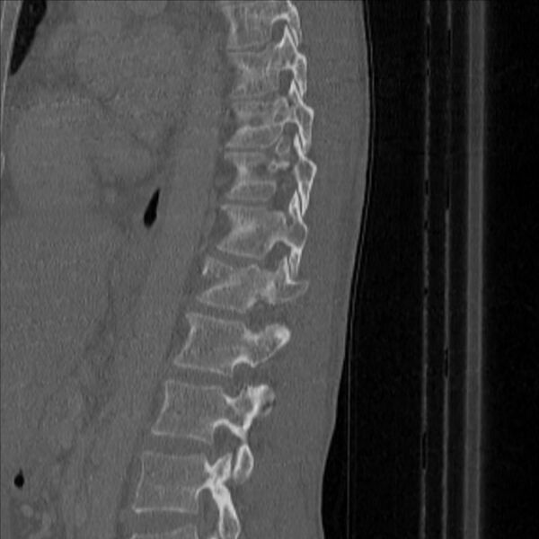 File:Bulging of paraspinal line in traumatic thoracal spinal compression fracture (Radiopaedia 29221-35872 Sagittal bone window 40).jpg