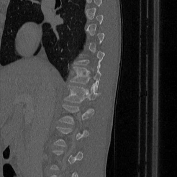 File:Bulging of paraspinal line in traumatic thoracal spinal compression fracture (Radiopaedia 29221-35872 Sagittal bone window 6).jpg