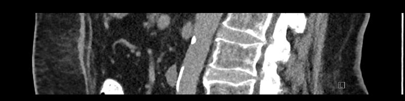 File:Buried bumper syndrome - gastrostomy tube (Radiopaedia 63843-72575 Sagittal Inject 61).jpg