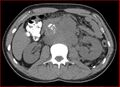 Burned-out testicular choriocarcinoma (Radiopaedia 32822-34040 Axial non-contrast 9).jpg