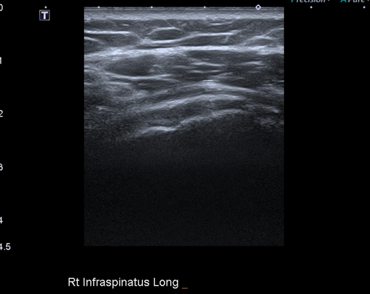 File:Calcific tendinitis (ruptured) (Radiopaedia 56393-63053 A 28).png