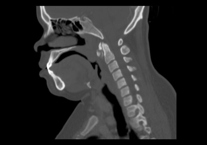 File:Calcific tendinitis of the longus colli muscle (Radiopaedia 28113-28371 Sagittal bone window 9).jpg