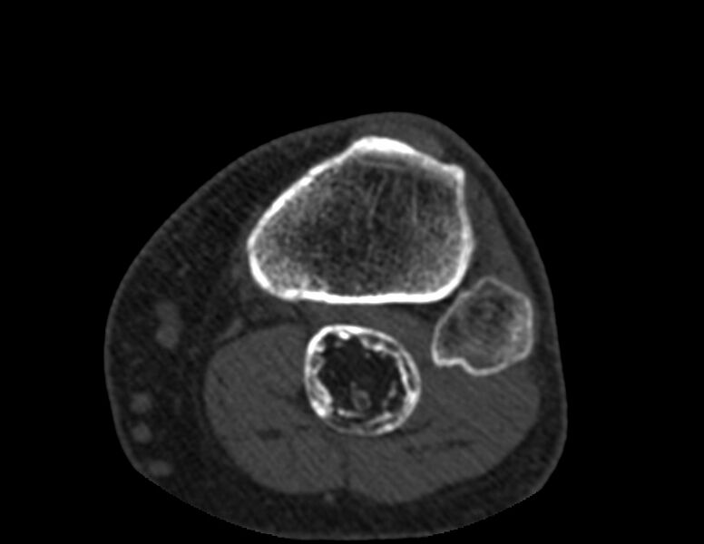 File:Calcified hematoma - popliteal fossa (Radiopaedia 63938-72763 Axial bone window 72).jpg