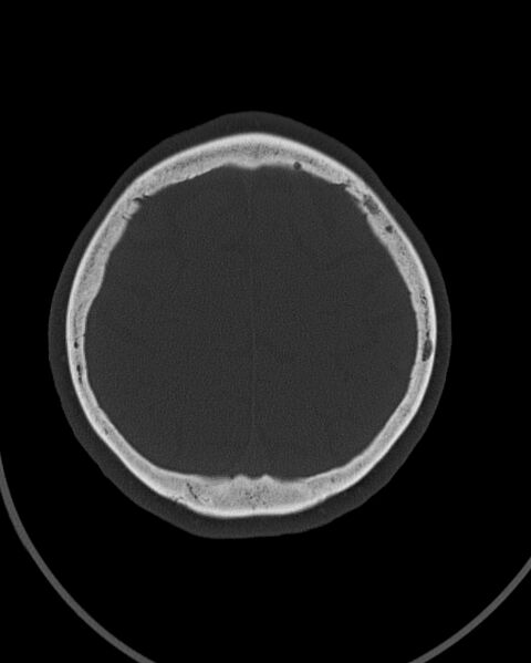 File:Calcified meningioma (Radiopaedia 74361-85243 Axial bone window 5).jpg
