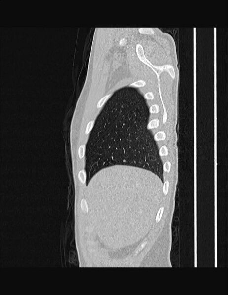 File:Calcifying pulmonary metastases (Radiopaedia 33359-34396 Sagittal lung window 63).jpg