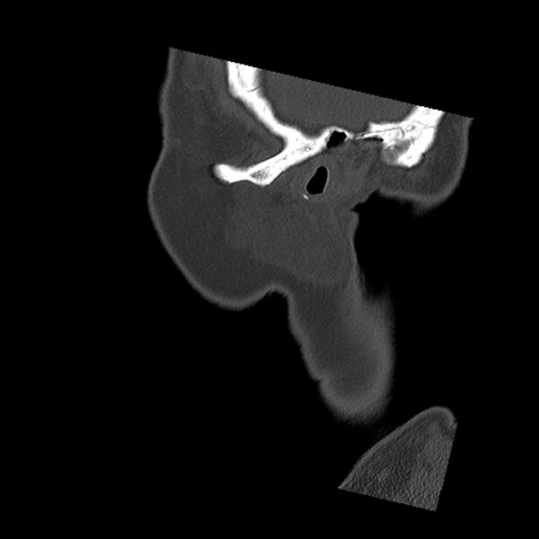 File:Canal up mastoidectomy (Radiopaedia 78108-90638 Sagittal bone window 6).jpg