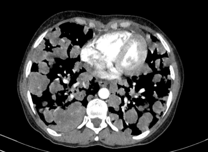File:Cannonball metastases from breast cancer (Radiopaedia 91024-108569 A 85).jpg