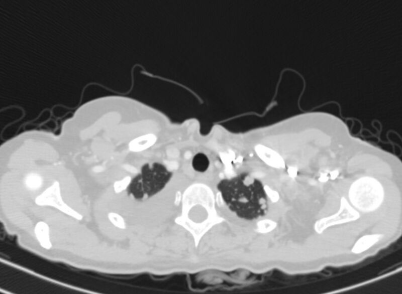 File:Cannonball metastases from breast cancer (Radiopaedia 91024-108569 Axial lung window 5).jpg
