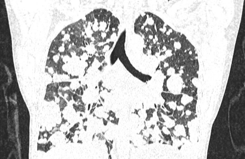File:Cannonball metastases from breast cancer (Radiopaedia 91024-108569 Coronal lung window 85).jpg